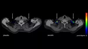 Imaging procedures show how brown fat is stimulated by the hormone secretion in a depot above the collarbone