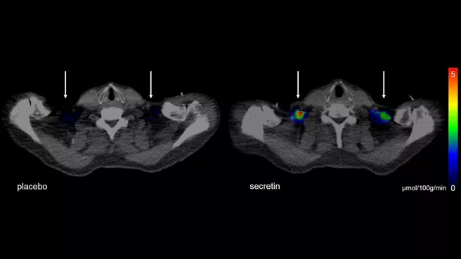 Imaging procedures show how brown fat is stimulated by the hormone secretion in a depot above the collarbone
