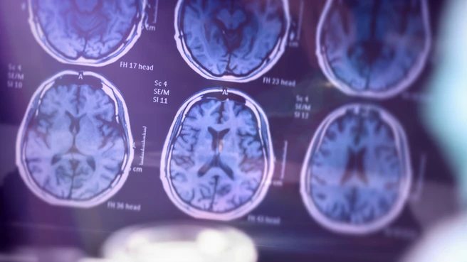 symbolic brain photo - Alzheimer's disease