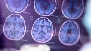 symbolic brain photo - Alzheimer's disease
